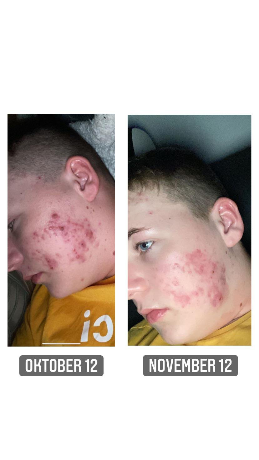 Discover How Much Is Accutane: A Complete Guide